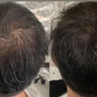 درمان ریزش مو|آرایشی، بهداشتی، درمانی|مشگین شهر, |دیوار