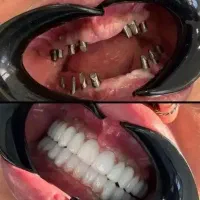 مرکزفوق تخصصی ایمپلنت دیجیتال/بدون درد/1روزه/اقساط