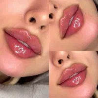 مدل فیلر لب گونه زاویه چونه فقط هزینه متریال ۷۰۰