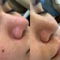 پاکسازی/پوست/فیشال/تخفیف ویژه