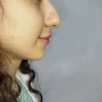 فیلر لب نچرال|خدمات آرایشگری و زیبایی|رشت, بلوار گیلان|دیوار