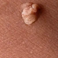 کلینیک اوینا درمان hpv و hsv و زگیل