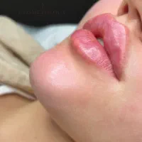 ژل لب گونه چانه،فول فیس لیفت نخ/لیزرآنزیم بوتاکس