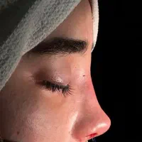 جراحی زیبای بینی پلک ژل فیلر بوتاکس مزوتراپی