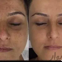 مدل فیشال ۲۸۰ت پاکسازی۱۵۰ت