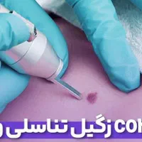 زگیل برداری میخچه برداری و...