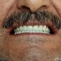 دندان مصنوعی متحرک|آرایشی، بهداشتی، درمانی|تهران, تهرانسر شرقی|دیوار