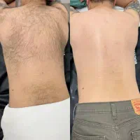 جشنواره لیزر موهای زائد در مطب پزشک
