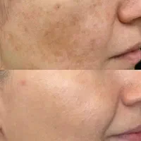 جای جوش و لک صورت و ....با ما برطرف کن|آرایشی، بهداشتی، درمانی|شیراز, دانشگاه شیراز|دیوار