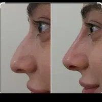 لیفت کامل بینی(اواتار) بدون جراحی به روش (NOA)