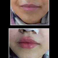 تزریق ژل بوتاکس آنزیم مزو ، خدمات پیرسینگ پرسینگ در صدرا-فارس، فاز ۱
