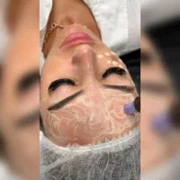 سفیدسازی پوست صورت ( ازبین بردن لکهای ملاسما )