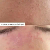 پاکسازی،فیشال درمان مشکلات پوستی|خدمات آرایشگری و زیبایی|زابل, |دیوار