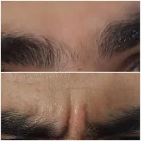 تخفیف ویژه‌ی خدمات ژل و بوتاکس بع مدت محدود|خدمات آرایشگری و زیبایی|ایذه, |دیوار