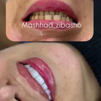 کامپوزیت لمینت بلچینگ روکش بلفارو غبغب لیفت صورت|خدمات آرایشگری و زیبایی|مشهد, فردوسی|دیوار