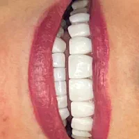 کامپوزیت دندان .۰لیرینگ .لمینت .ونیر|خدمات آرایشگری و زیبایی|ری, تقی آباد|دیوار