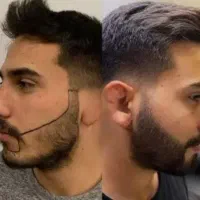 کاشت مو و کاشت ابرو، میکروگرافت