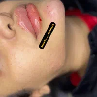 تزریق ژل لب و بوتاکس|خدمات آرایشگری و زیبایی|شیراز, شهرک مهدی‌آباد|دیوار