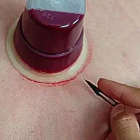 اخبانه + حجامت وبادکش درمانی