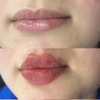 تخفیف پاییزی ژل و بوتاکس، انزیم، فیلر، درخدمتیم