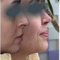 کاشت مو، کاشت ابرو، بلفارو، عمل بینی، رفع غبغب|خدمات آرایشگری و زیبایی|کرج, فاز ۱ مهرشهر|دیوار