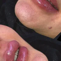 ژل و بوتاکس