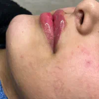 خدمات فیلر و بوتاکس|خدمات آرایشگری و زیبایی|خرمشهر, |دیوار