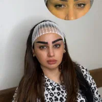 کاشت ابرو دائمی بدون بخیه بدون برش با خواب طبیعی