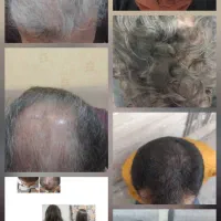 پک ضد ریزش مو و کرم ژرنات مبتکر دکتر بختیاری|آرایشی، بهداشتی، درمانی|قم, شهرک قدس|دیوار