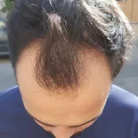 کاشت موبه روشfitتیم متخصص ومجرب ازشیراز