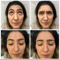 آموزش وتزریق،ژل،بوتاکس،مزوژل زیرچشم،آنزیم ومزو|خدمات آرایشگری و زیبایی|کرج, فاز ۳ گوهردشت|دیوار
