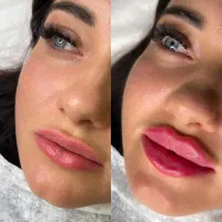 لیفت صورت بانخ ژل.افزایش سایزآلت تناسلی درمطب دکتر