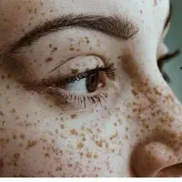 درمان و لیزر تضمینی کک و مک و لک فقط در 1 جلسه|خدمات آرایشگری و زیبایی|اصفهان, لاله|دیوار