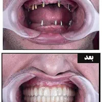 ایمپلنت دیجیتال/ارتودنسی/پروتز دندان/بلیچینگ