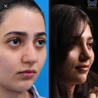 عمل جراحی بینی لیفت خدمات زیبایی با متد پیشرفته|خدمات آرایشگری و زیبایی|کرج, گلشهر|دیوار