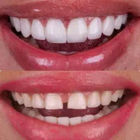 طرح لبخند*بی‌نظیرترین کیفیت*کمترین قیمت دندانپزشکی|خدمات آرایشگری و زیبایی|شیراز, ملاصدرا|دیوار