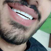 اموزش کامپوزیت دندان با مدرک