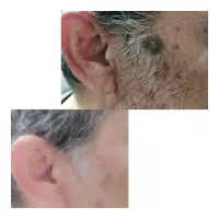 برداشتن خالهای گوشتی و سطحی|خدمات آرایشگری و زیبایی|کرج, عظیمیه|دیوار