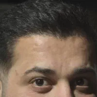 کاشت مو و ابرو