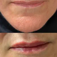 جشنواره ژل گونه، چانه، زاویه فک و لب|خدمات زیبایی و سلامت|تهران, میدان ولیعصر|دیوار