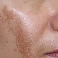 لک صورت راهنمایی .. ملاسما