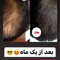 ریزش ورویش مو