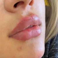 آموزش و خدمات ژل و بوتاکس هر سیسی 590در مطب تخصصی|خدمات آرایشگری و زیبایی|اصفهان, رکن الدوله شرقی|دیوار