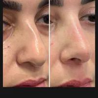 لیفت نوک جمعکردن پره بینی بدون جراحی آنزیم فیلربین