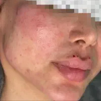 ژل بوتاکس فیشال آرایش دایم