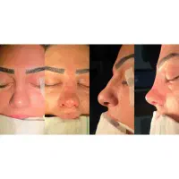 جراحی زیبایی بینی توسط متخصص گوش حلق بینی