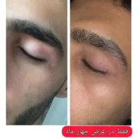 پیسی و پسوریازیس|خدمات آرایشگری و زیبایی|کرمانشاه, |دیوار