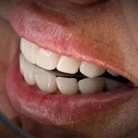 کامپوزیت دیجیتال و لمینیت با شرایط استثنایی در لار|خدمات آرایشگری و زیبایی|لار, |دیوار