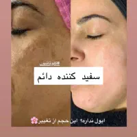 گلوتاتیون/درمان پیسی/روشن کننده کل صورت وبدن