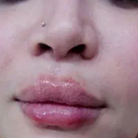 تزریق ژل در سهیلیه